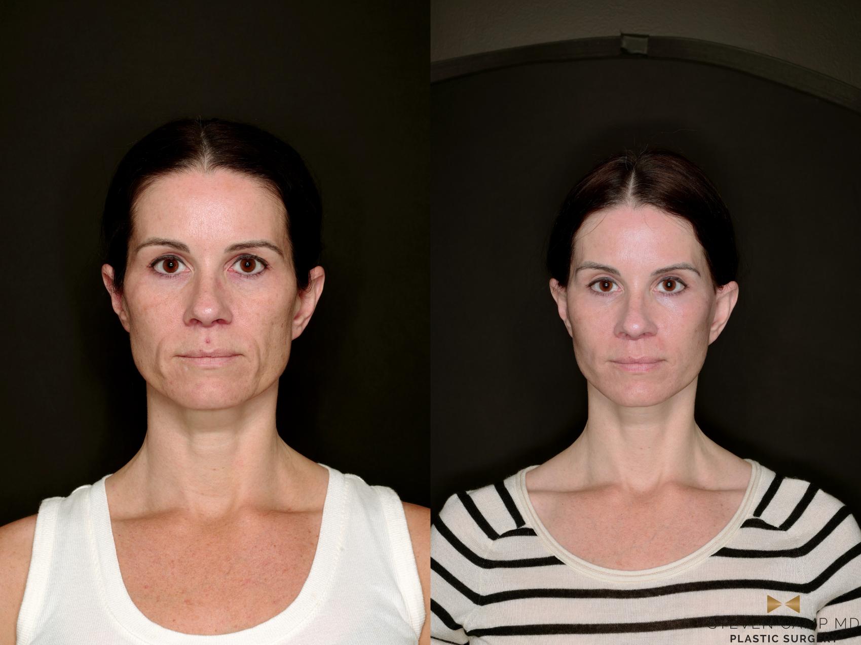 Before & After Deep Plane Facelift Case 787 Front View in Fort Worth & Arlington, Texas