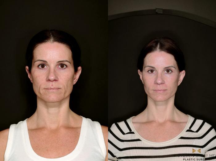 Before & After Deep Plane Facelift Case 787 Front View in Fort Worth & Arlington, Texas