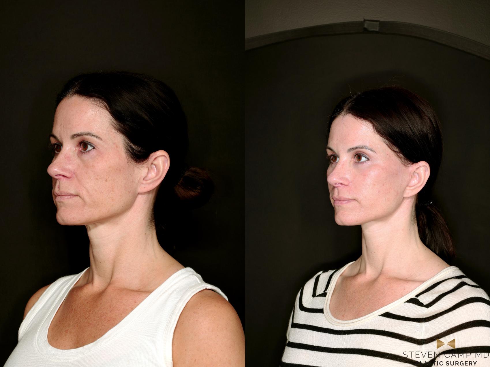 Before & After Deep Plane Facelift Case 787 Left Oblique View in Fort Worth & Arlington, Texas