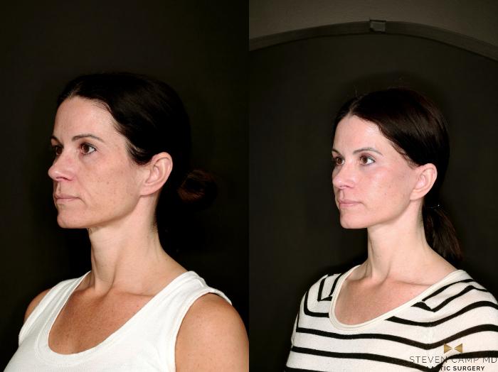 Before & After Deep Plane Facelift Case 787 Left Oblique View in Fort Worth & Arlington, Texas