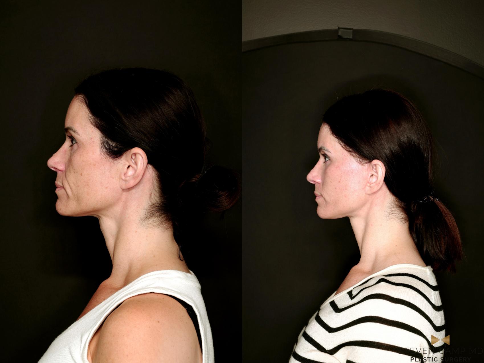 Before & After Deep Plane Facelift Case 787 Left Side View in Fort Worth & Arlington, Texas