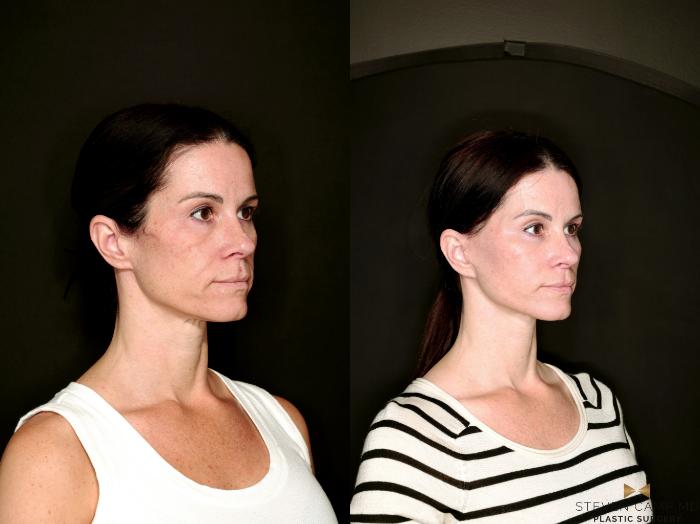Before & After Deep Plane Facelift Case 787 Right Oblique View in Fort Worth & Arlington, Texas