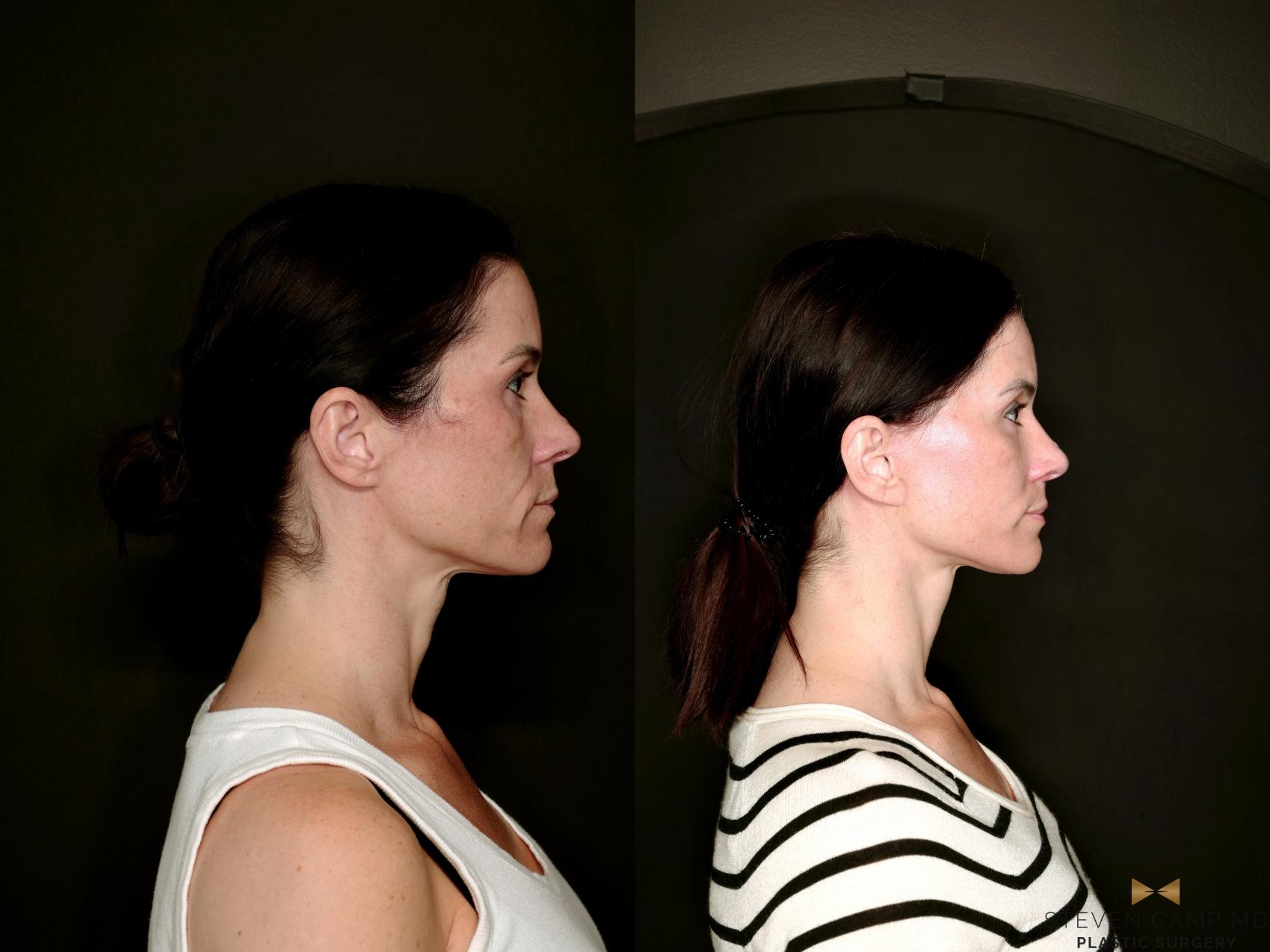 Before & After Deep Plane Facelift Case 787 Right Side View in Fort Worth & Arlington, Texas