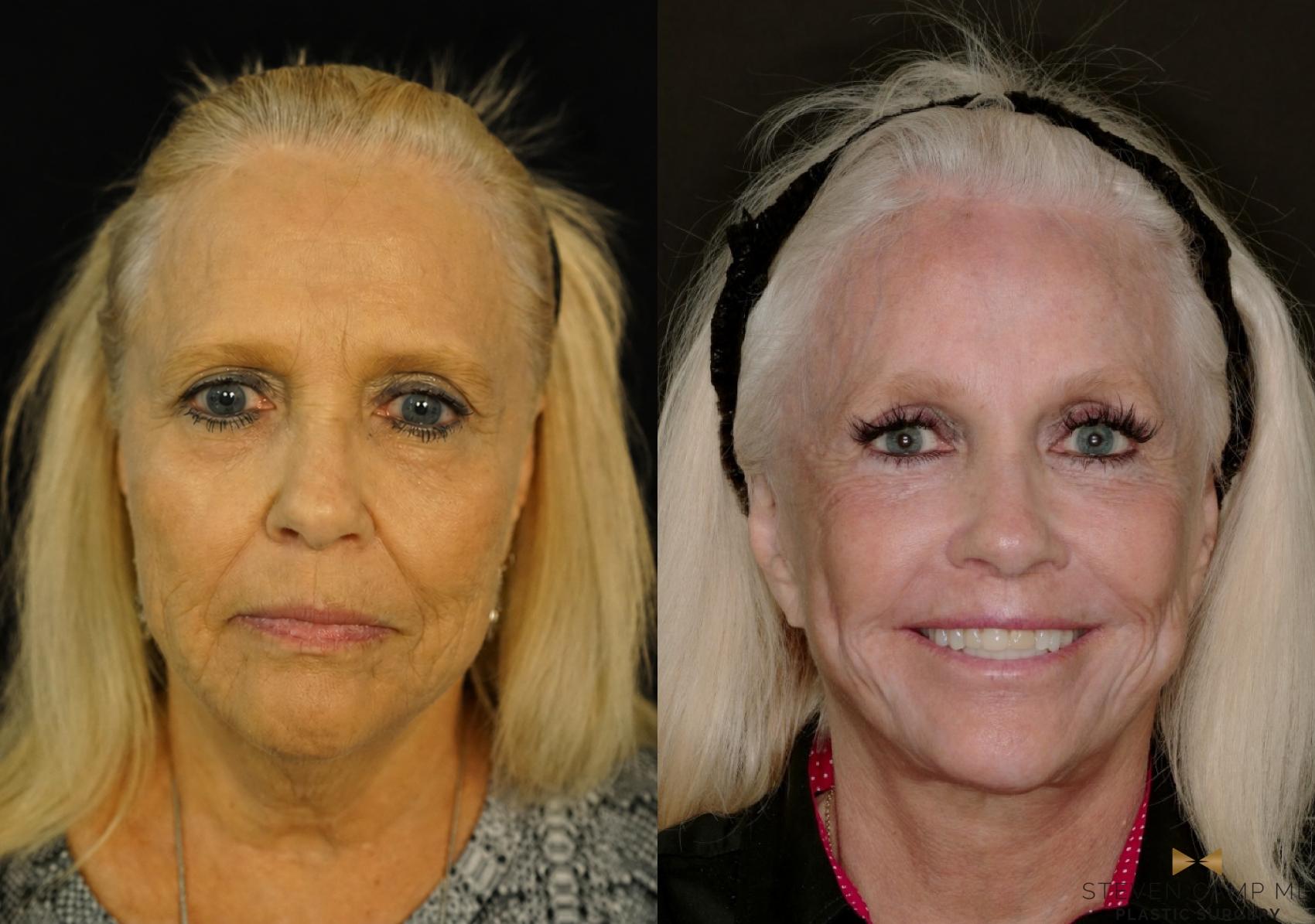 Before & After Deep Plane Facelift Case 794 Front View in Fort Worth & Arlington, Texas