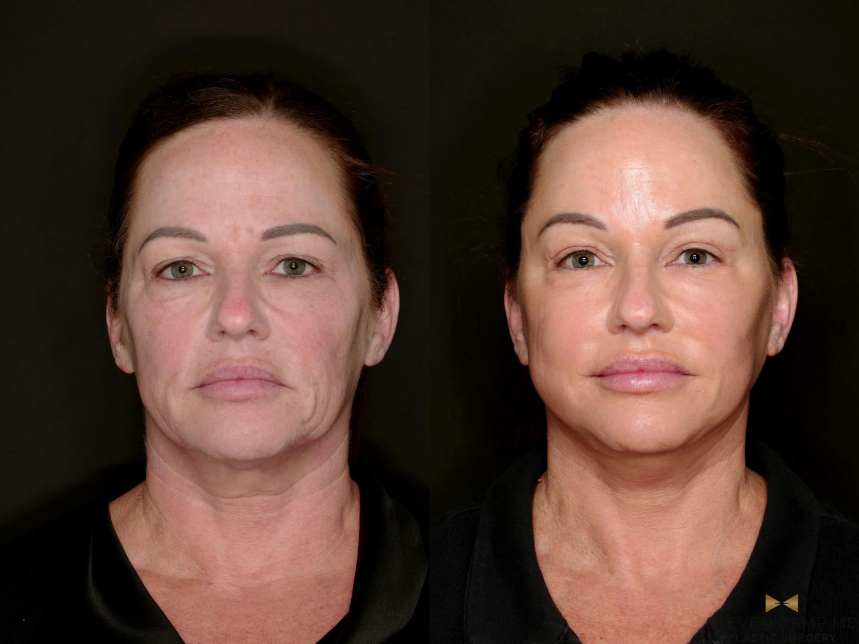 Before & After Deep Plane Facelift Case 802 Front View in Fort Worth & Arlington, Texas