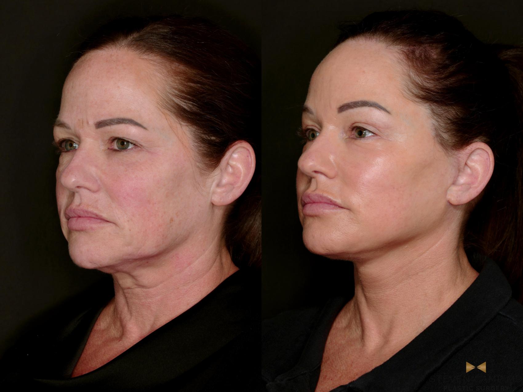Before & After Deep Plane Facelift Case 802 Left Oblique View in Fort Worth & Arlington, Texas