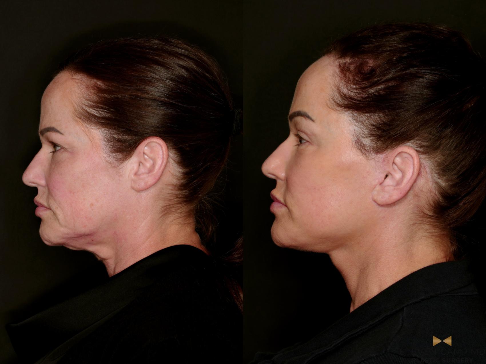 Before & After Deep Plane Facelift Case 802 Left Side View in Fort Worth & Arlington, Texas