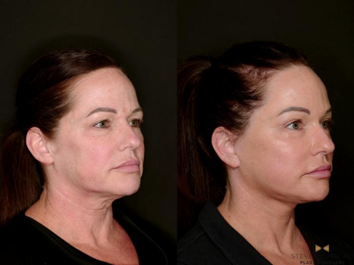 Before & After Deep Plane Facelift Case 802 Right Oblique View in Fort Worth & Arlington, Texas