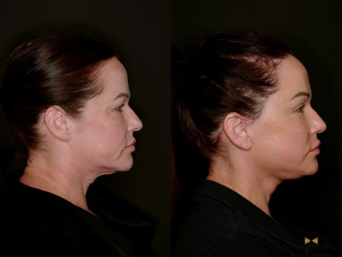 Before & After Deep Plane Facelift Case 802 Right Side View in Fort Worth & Arlington, Texas