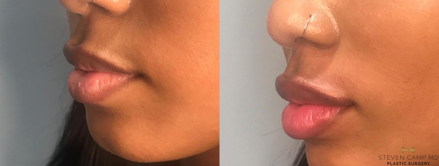 Before & After Dermal Fillers Case 174 View #1 View in Fort Worth, Texas