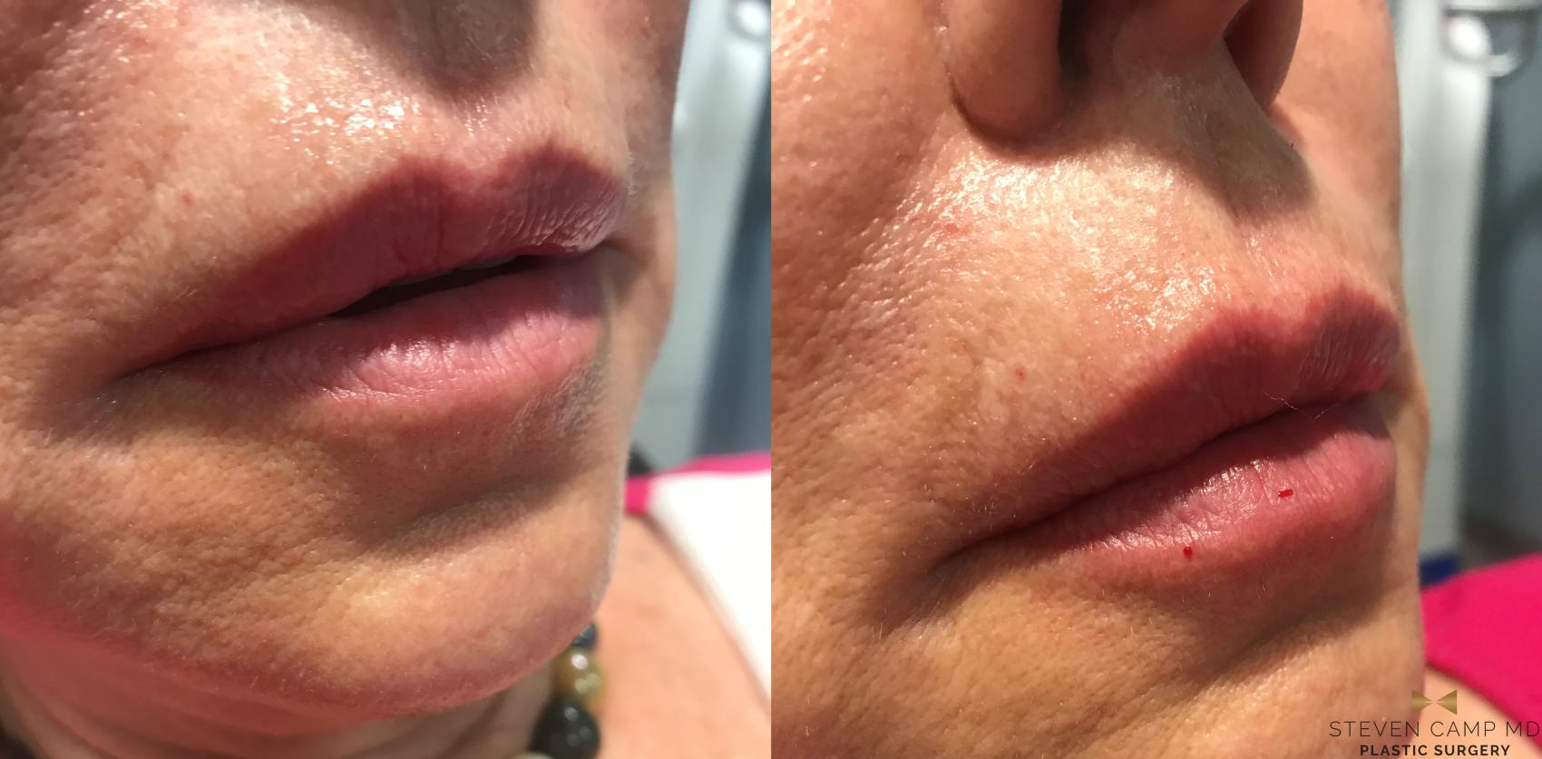 Before & After Dermal Fillers Case 175 View #1 View in Fort Worth & Arlington, Texas