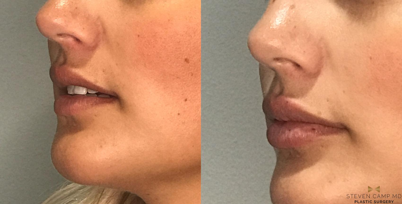 Before & After Dermal Fillers Case 176 View #1 View in Fort Worth & Arlington, Texas