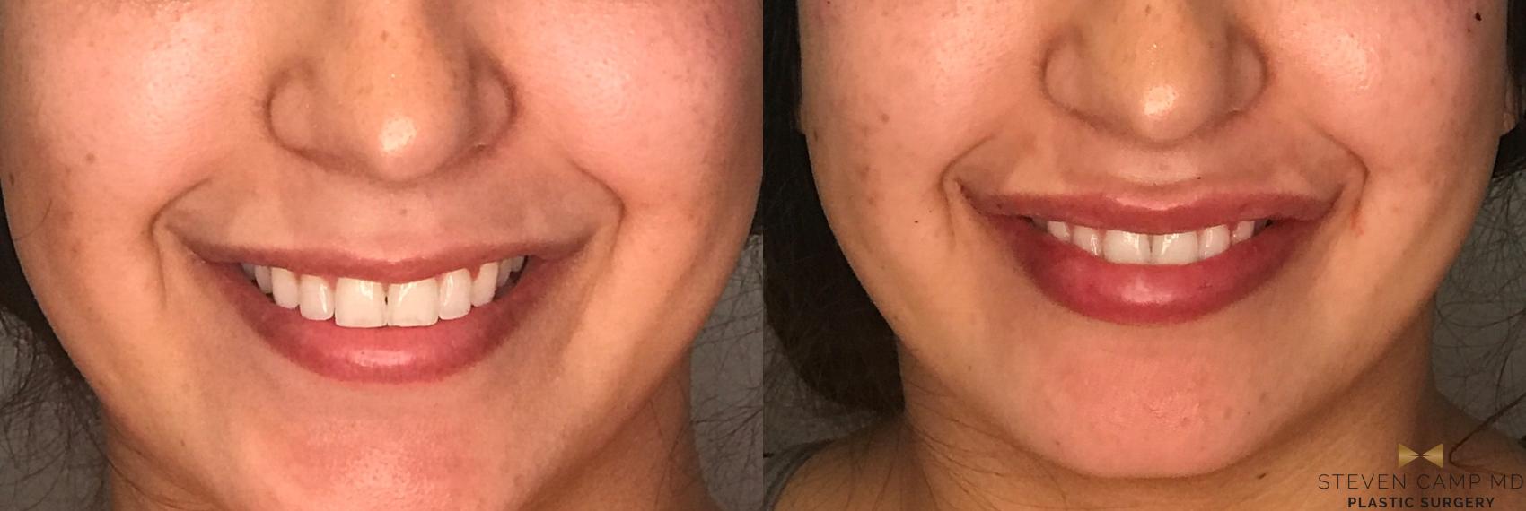 Before & After Dermal Fillers Case 177 View #1 View in Fort Worth & Arlington, Texas