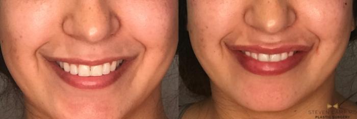 Before & After Dermal Fillers Case 177 View #1 View in Fort Worth, Texas