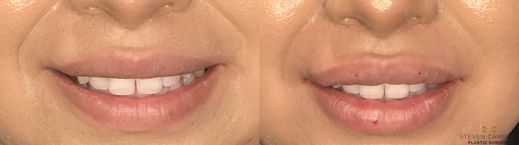 Before & After Dermal Fillers Case 178 View #1 View in Fort Worth & Arlington, Texas