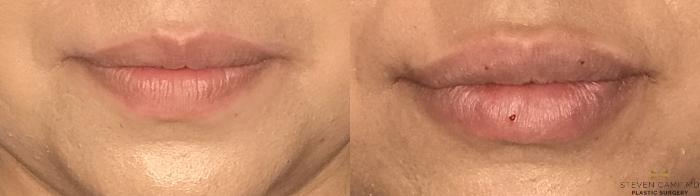 Before & After Dermal Fillers Case 178 View #2 View in Fort Worth & Arlington, Texas