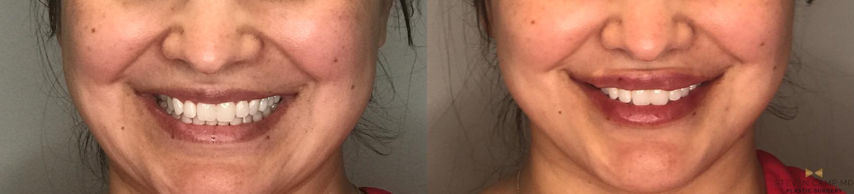 Before & After Dermal Fillers Case 180 View #1 View in Fort Worth & Arlington, Texas