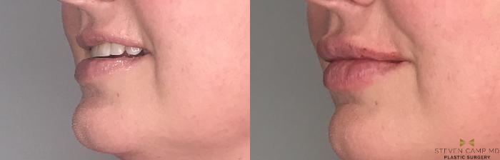 Before & After Dermal Fillers Case 184 View #1 View in Fort Worth, Texas