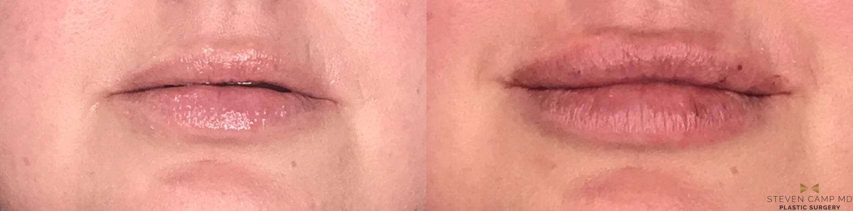 Before & After Dermal Fillers Case 184 View #2 View in Fort Worth & Arlington, Texas