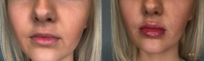 Before & After Dermal Fillers Case 186 View #1 View in Fort Worth, Texas