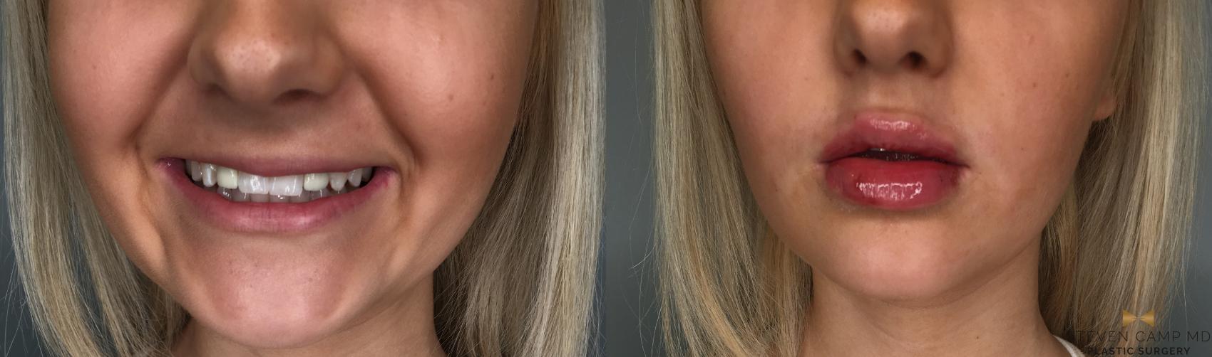 Before & After Dermal Fillers Case 186 View #2 View in Fort Worth, Texas