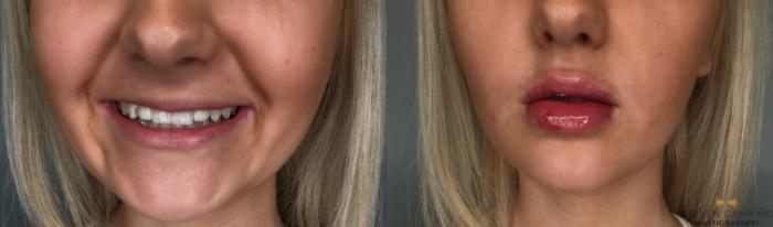 Before & After Dermal Fillers Case 186 View #2 View in Fort Worth & Arlington, Texas