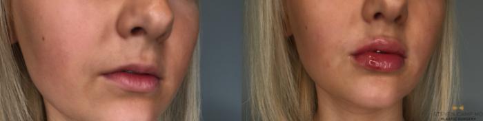 Before & After Dermal Fillers Case 186 View #4 View in Fort Worth, Texas