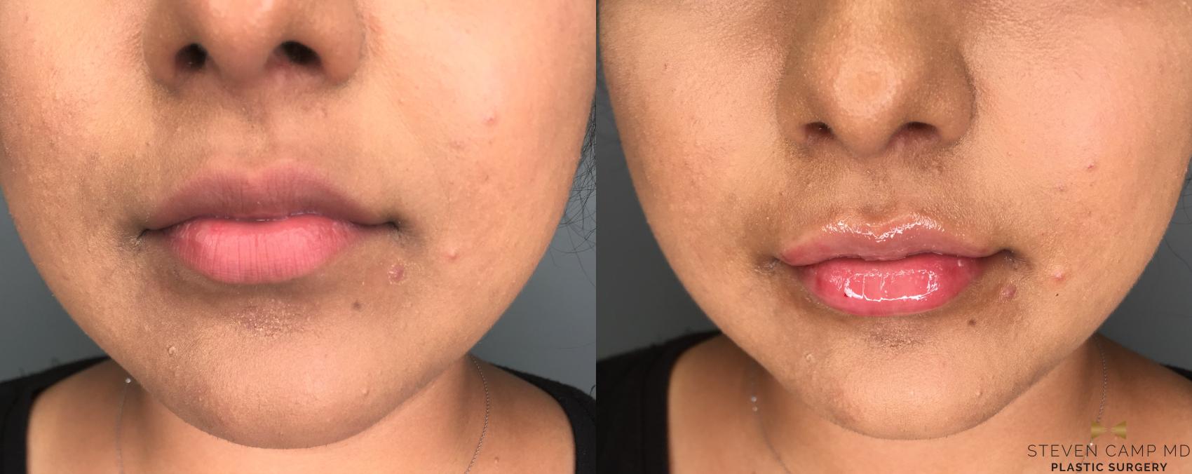 Before & After Dermal Fillers Case 188 View #1 View in Fort Worth & Arlington, Texas