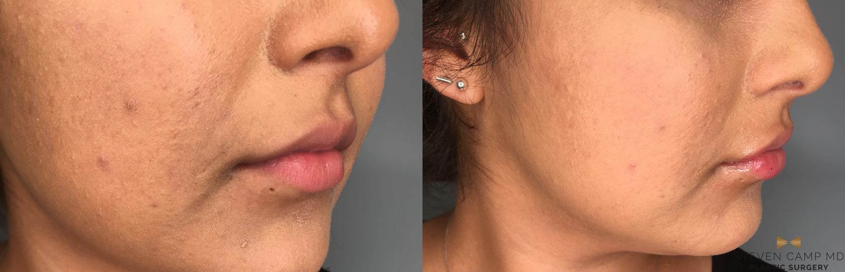 Before & After Dermal Fillers Case 188 View #2 View in Fort Worth, Texas