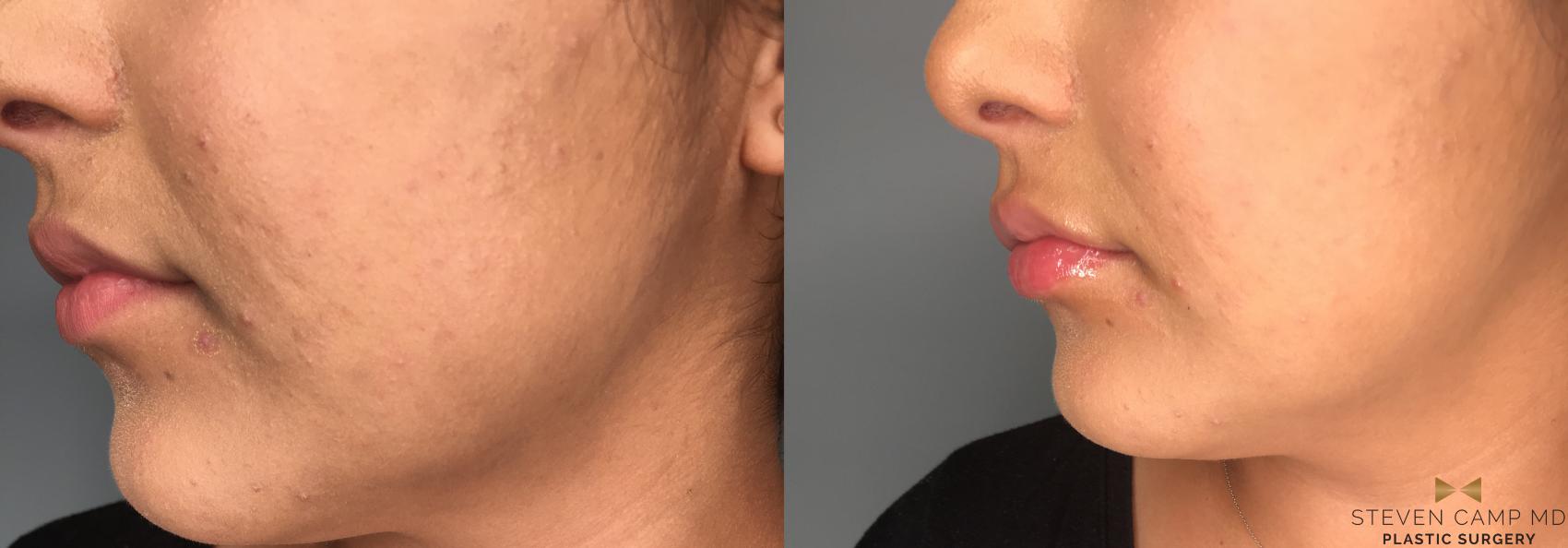 Before & After Dermal Fillers Case 188 View #3 View in Fort Worth, Texas