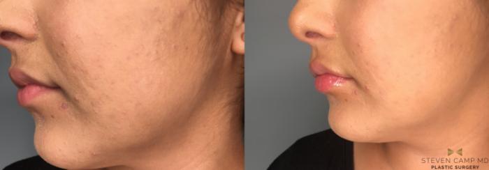 Before & After Dermal Fillers Case 188 View #3 View in Fort Worth & Arlington, Texas