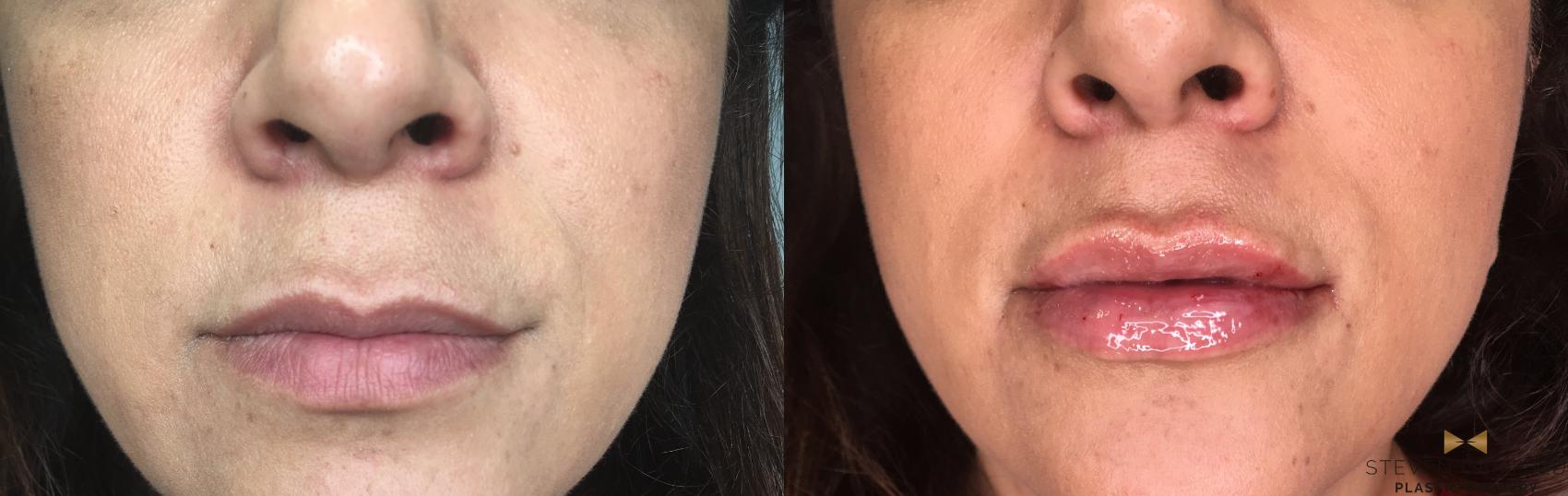 Before & After Dermal Fillers Case 189 View #1 View in Fort Worth & Arlington, Texas