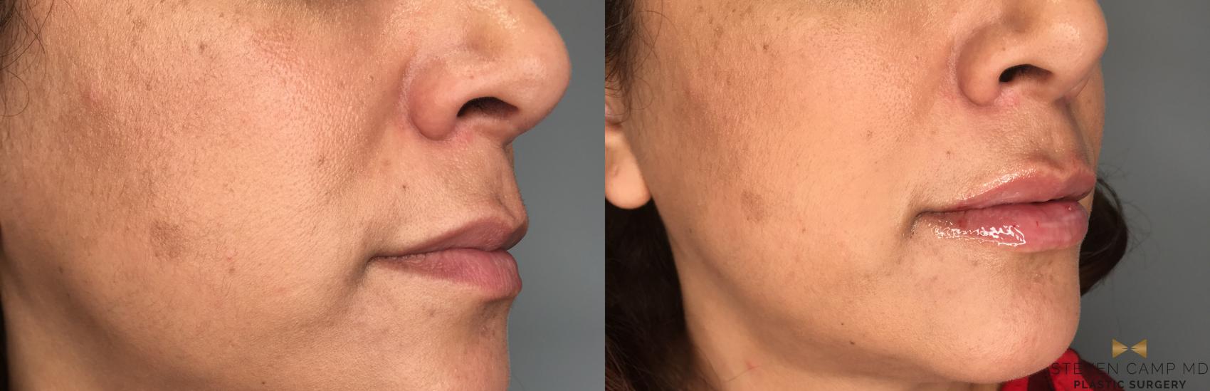 Before & After Dermal Fillers Case 189 View #2 View in Fort Worth & Arlington, Texas