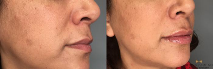 Before & After Dermal Fillers Case 189 View #2 View in Fort Worth, Texas