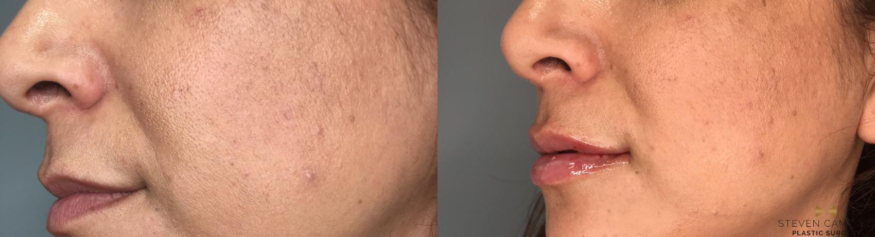 Before & After Dermal Fillers Case 189 View #3 View in Fort Worth & Arlington, Texas