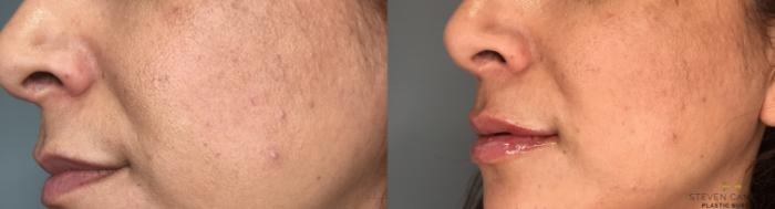 Before & After Dermal Fillers Case 189 View #3 View in Fort Worth, Texas