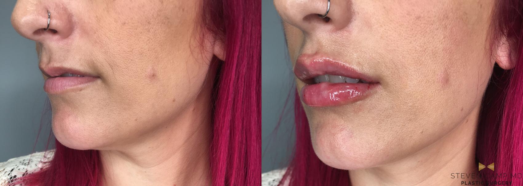 Before & After Dermal Fillers Case 190 View #2 View in Fort Worth & Arlington, Texas