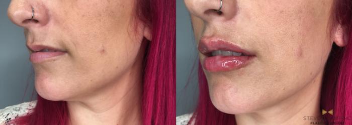 Before & After Dermal Fillers Case 190 View #2 View in Fort Worth, Texas