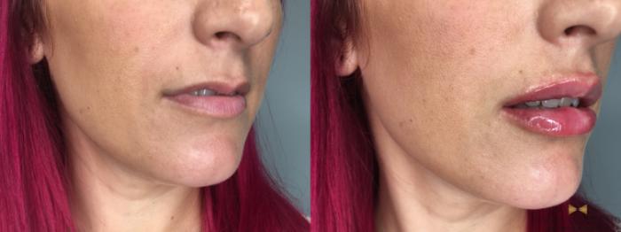 Before & After Dermal Fillers Case 190 View #3 View in Fort Worth, Texas
