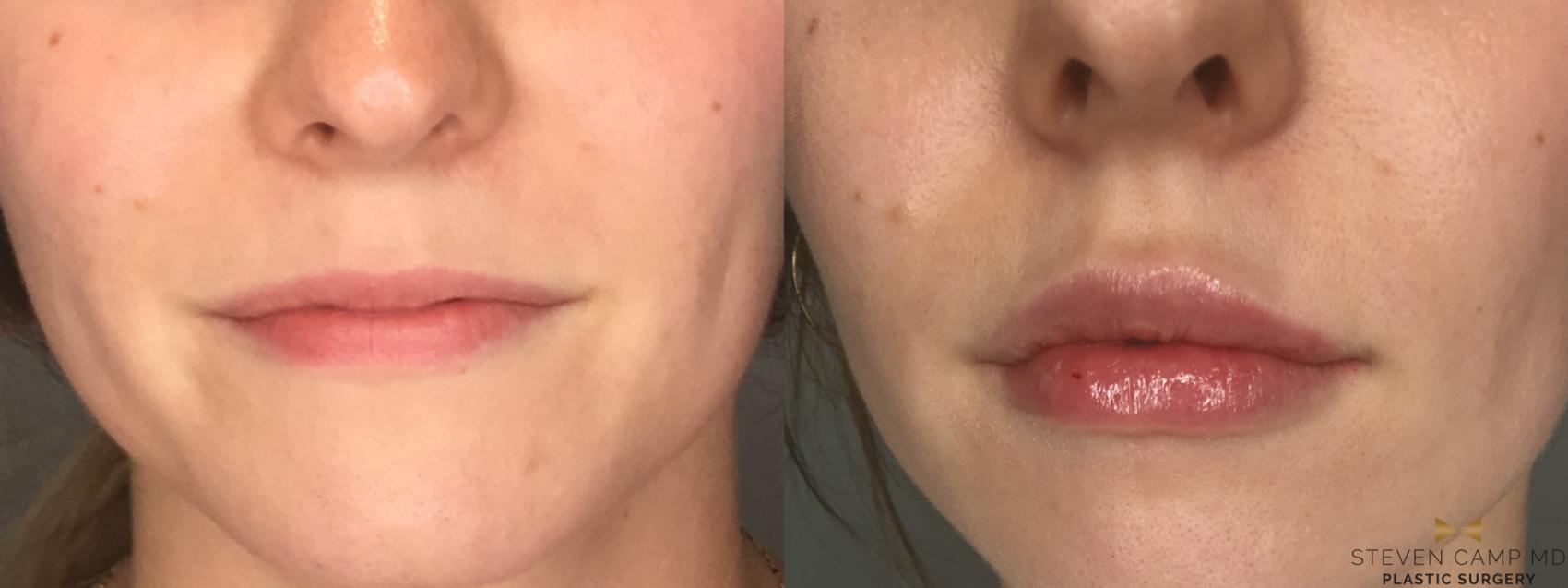 Before & After Dermal Fillers Case 191 View #1 View in Fort Worth & Arlington, Texas