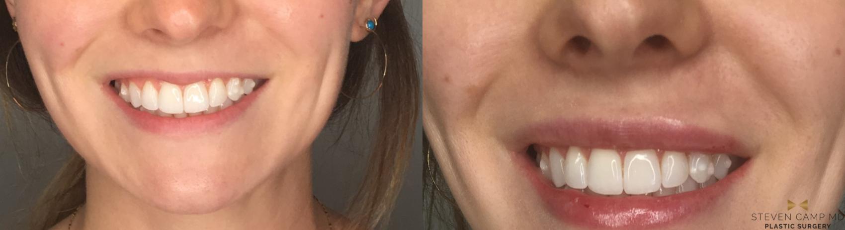 Before & After Dermal Fillers Case 191 View #2 View in Fort Worth & Arlington, Texas