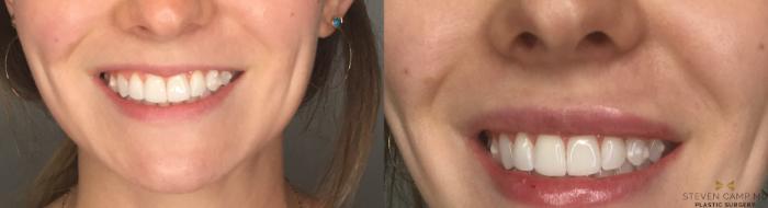 Before & After Dermal Fillers Case 191 View #2 View in Fort Worth, Texas