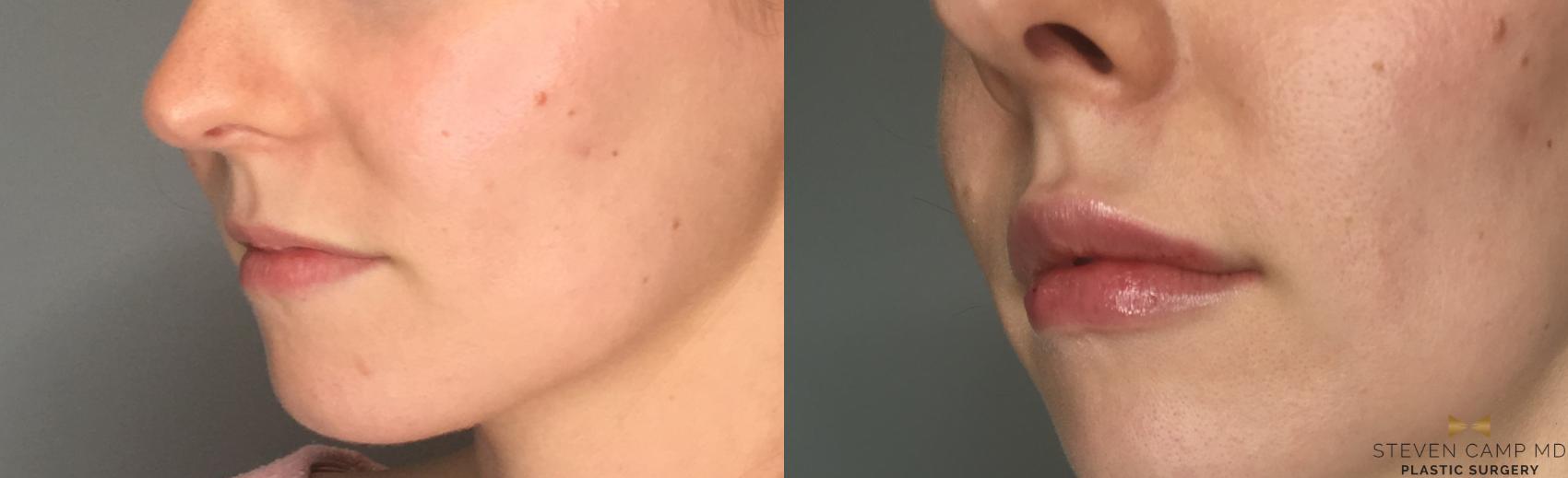 Before & After Dermal Fillers Case 191 View #3 View in Fort Worth & Arlington, Texas