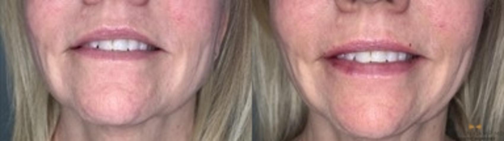 Before & After Dermal Fillers Case 359 Front View in Fort Worth & Arlington, Texas