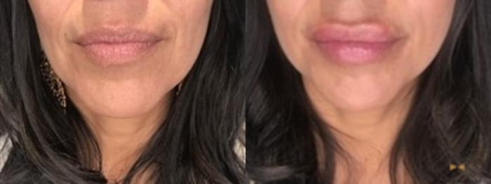 Before & After Dermal Fillers Case 360 Front View in Fort Worth & Arlington, Texas