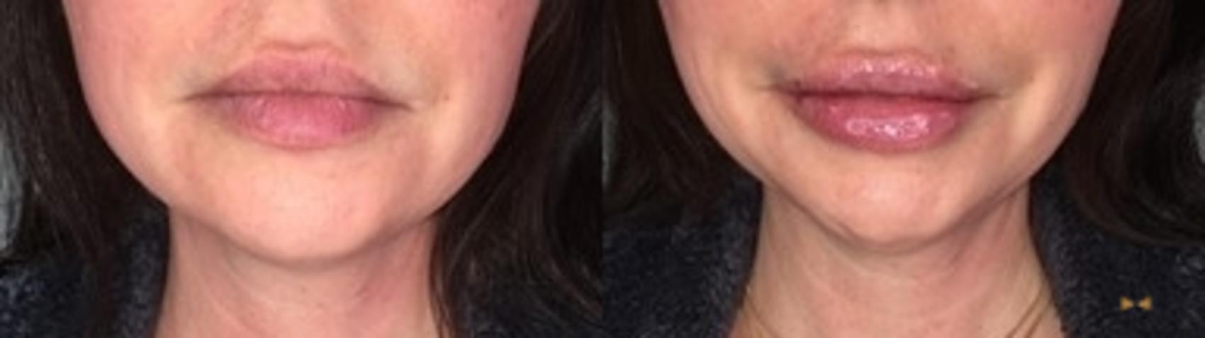 Before & After Dermal Fillers Case 361 Front View in Fort Worth & Arlington, Texas