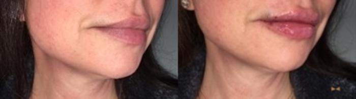Before & After Dermal Fillers Case 361 Right Oblique View in Fort Worth & Arlington, Texas