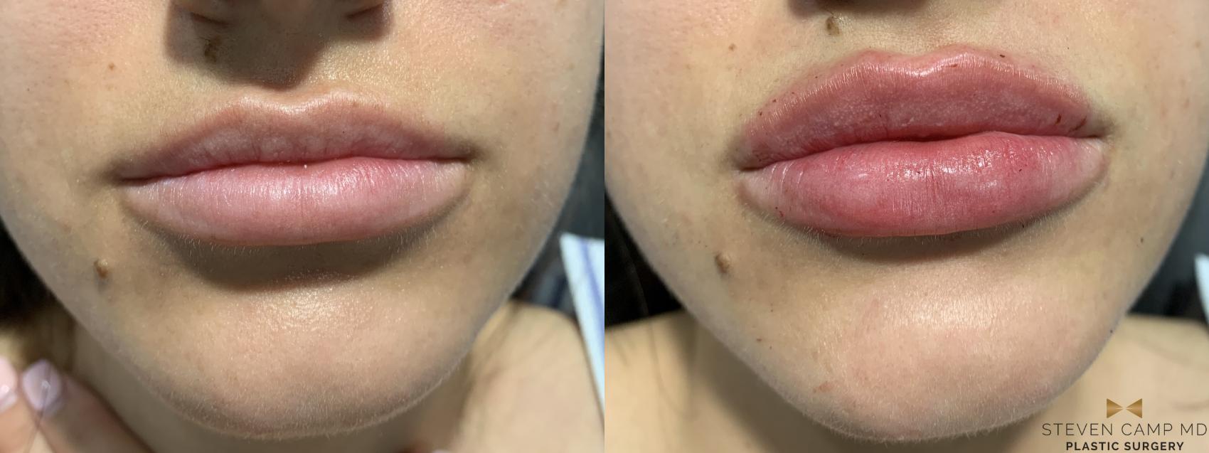 Before & After Dermal Fillers Case 367 Front View in Fort Worth & Arlington, Texas