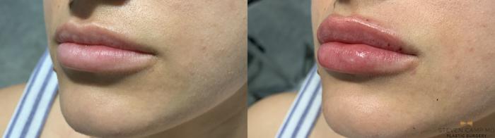 Before & After Dermal Fillers Case 367 Left Oblique View in Fort Worth & Arlington, Texas