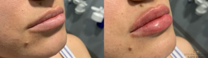 Before & After Dermal Fillers Case 367 Right Oblique View in Fort Worth & Arlington, Texas